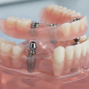 Overdenture Attachment